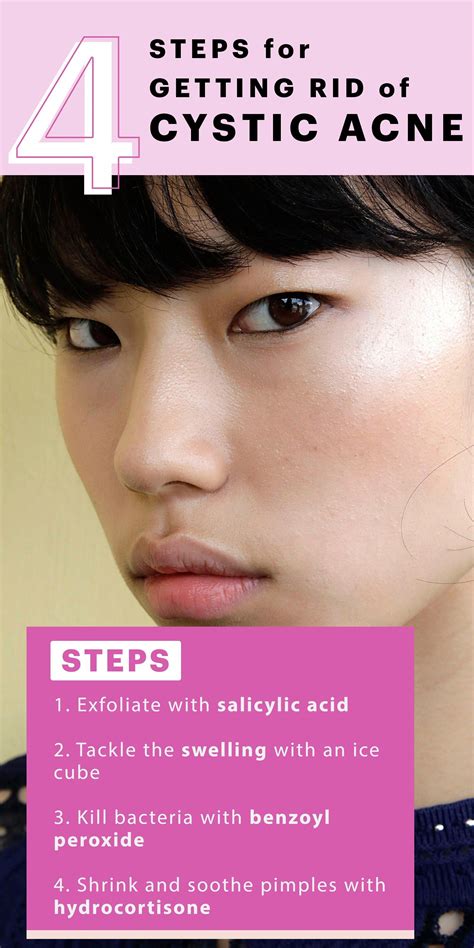 4 Easy Ways To Clear Cystic Acne — No Popping Required Acnetips