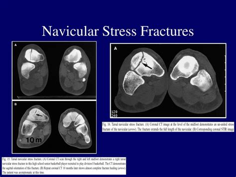 Ppt Foot Stress Fractures Powerpoint Presentation Free Download Id