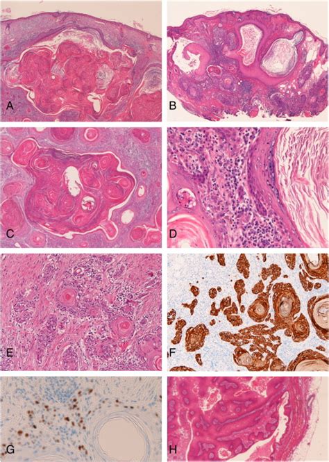Histological Features A Squamous Cell Carcinoma Scc Arising From An