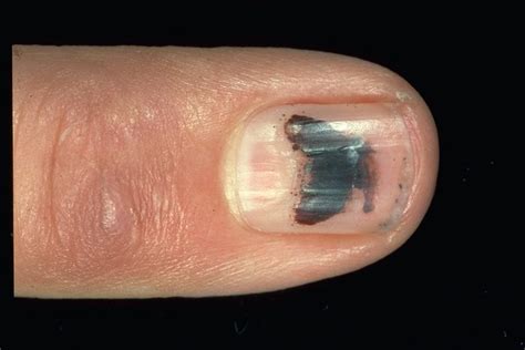 15 Health Warnings Your Fingernails Are Sending