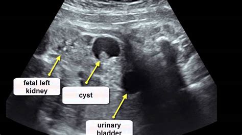 Prenatal Ultrasonographic Features Of Mature Cystic Teratoma In