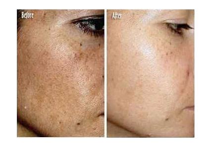 I was so amazed with this product i started telling all my friends and family about it. 683 best images about Meladerm Skin Lightening Cream For ...