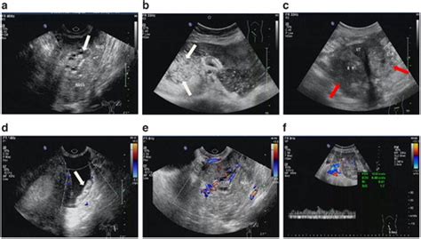 The Multimodal Ultrasound Features Of Ovarian Serous Surface Papillary