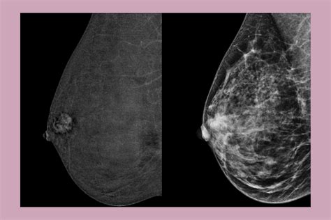 Contrast Enhanced Mammography A Game Changer