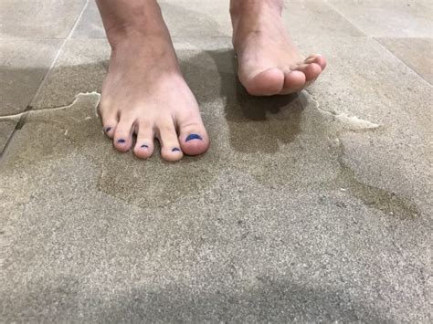 Treating Foot Sweating With Botox Botox For Feet Cincinnati