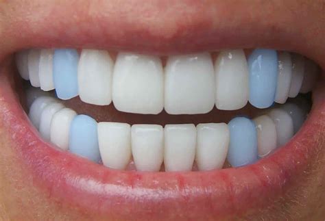 Dente Canino Humano Pontudo