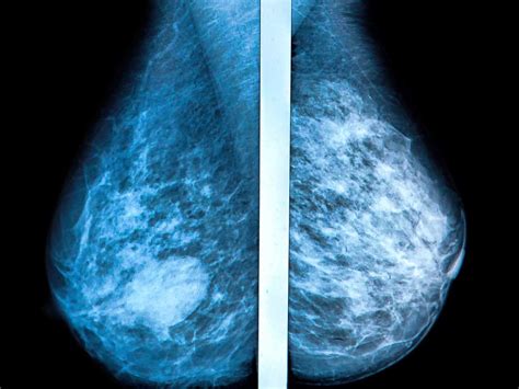 Instead, breast skin can become thick, red, and look pitted. Mammogram images: Normal, abnormal, and breast cancer