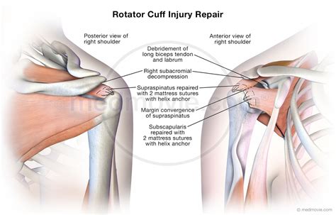 Rotator Cuff Injury Repair Medmovie