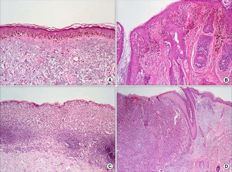 Histopathologic Features Of Cutaneous Melanoma Lentigo Maligna