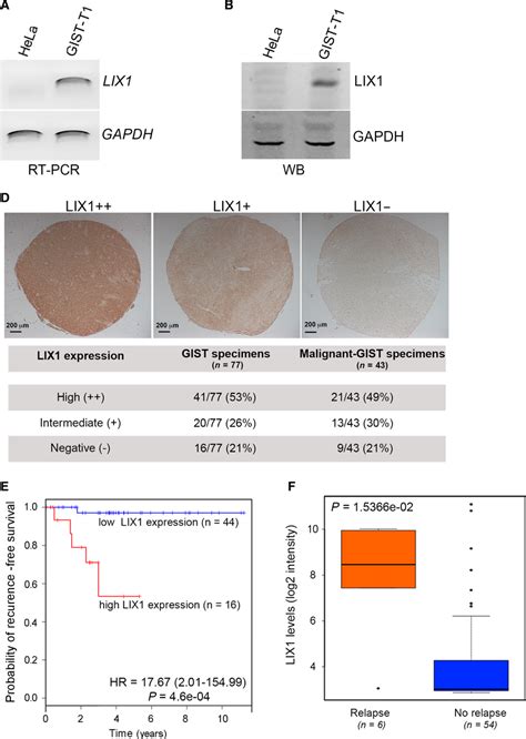 LIX1 Is Expressed In GIST Samples And The GISTT1 Cell Line A