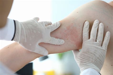 Eczema ótico Síntomas Causas Y Tratamiento Muy Salud