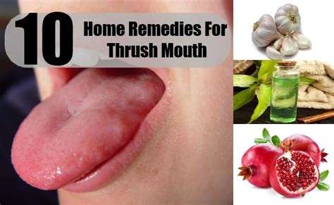10 Home Remedies For Thrush Mouth Home Remedies For Thrush Home
