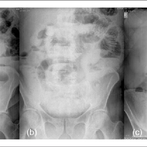 Abdominal Radiographs Erect Position At Three Days A Four Days