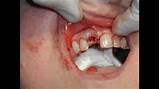 Pictures of Bone Graft Recovery