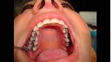 Photos of Dental Silver Fillings