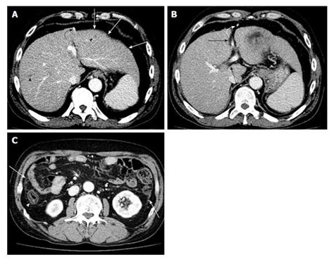 Ct Scan Liver Cirrhosis