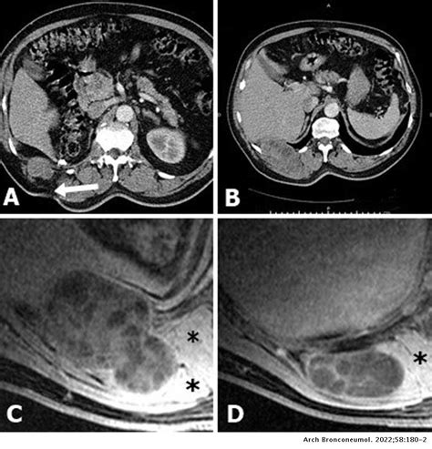 Delayed Chest Wall Recurrence Of Hydatid Cyst Fifty Years After