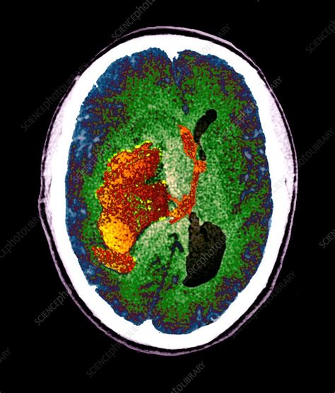 Stroke And Brain Damage Ct Scan Stock Image C0474983 Science