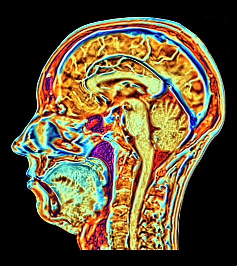 Female Normal Mri Brain