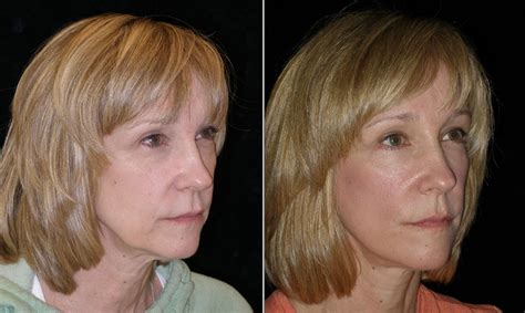 mini facelift 54yo female patient aesthetica cosmetic surgery and laser center