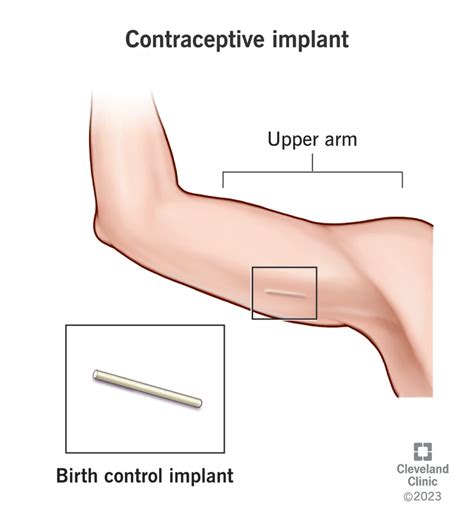 Birth Control Implant How It Works Side Effects And Benefits