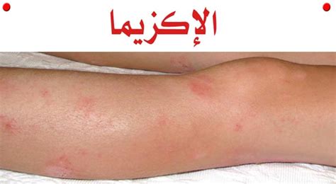 حساسية الجلد عند الأطفال أسباب، أعراض، علاج