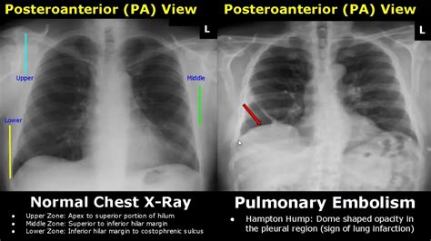 Chest X Ray Lung Normal Vs Abnormal Image Appearances Part Pleural Effusion Pneumothorax PA