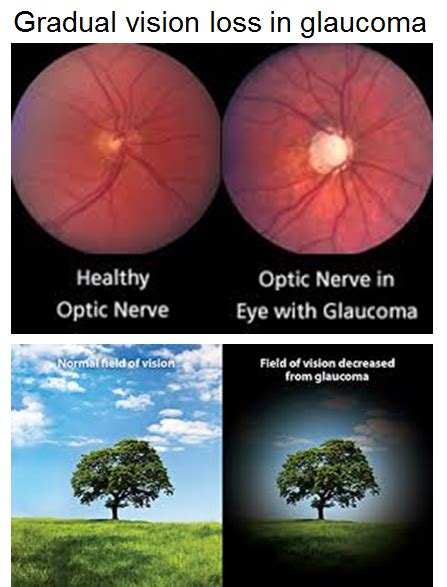 Glaucoma Vs Cataracts — View Optometry Optometrist In North Vancouver