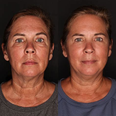 Morpheus 8 Before And After Kaado Aesthetics And Anti Aging Medicine