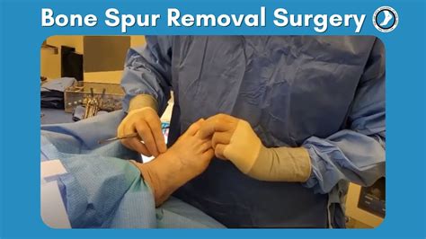 Bone Spur Removal Surgery In The Top Of The Foot Youtube