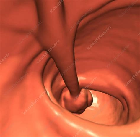 Colon Polyp Ct Scan Stock Image C0234568 Science Photo Library