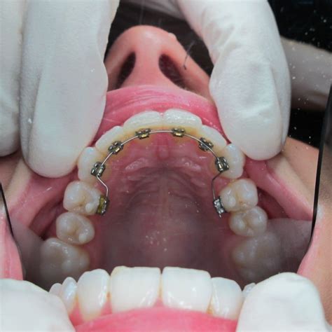 Behind Teeth Braces In Gourock
