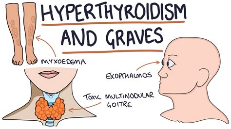 Understanding Hyperthyroidism And Graves Disease Youtube