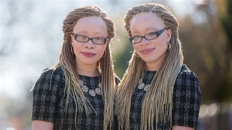 These Albino Twins Are Not Allowing Their Condition Hold Them Back From