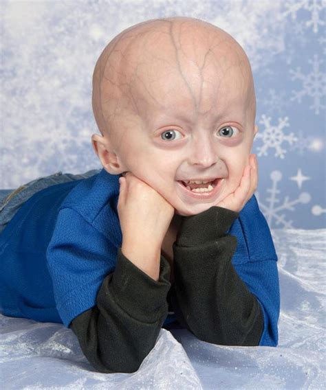 Progeria Syndrome Facts Symptoms Causes Treatment Home Remedies