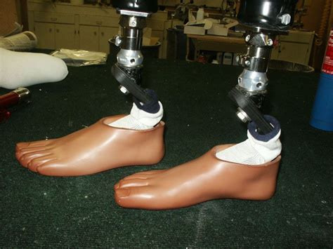 Prosthetic Feet At Rs 35000unit प्रोस्थेटिक फुट Quality Artficial