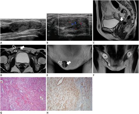 Androgen Insensitivity Syndrome As Related To Klinefelter Syndrome Pictures