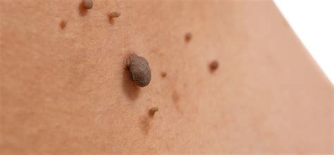The Shocking Truth About Moles