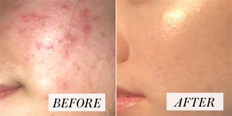 Woman S Skin Care Routine For Acne Goes Viral Before And After Photos Allure