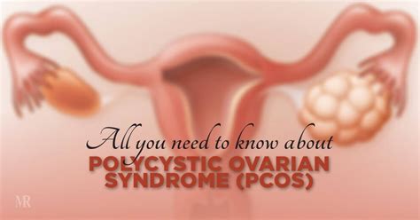 all you need to know about polycystic ovarian syndrome pcos mr