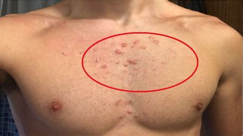 How To Get Rid Of Chest Acne Scars Fast Youtube