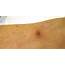 Squamous Cell Carcinoma Treatment  Norris Dermatology Portland