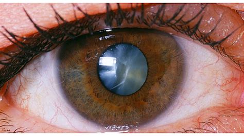 Cataract Safesight Eye Surgery