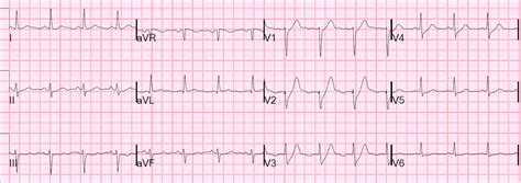 Original reports of the de winter pattern suggested that the ecg did not change or. Dr. Smith's ECG Blog: Is the LAD really completely ...