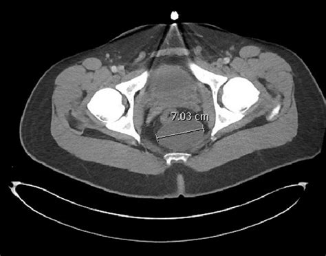 Ct Pelvis Image Demonstrating A 70 Cm Retrorectal Cyst The Rectum Is
