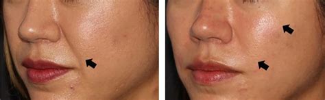 Cheek Enhancement With Dermal Fillers At Define Medical Clinic Beaconsfield