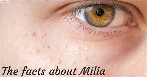 Everything You Need To Know About Milia The Fuss