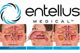 Entellus Medical Inc Pictures