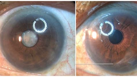 phacoemulsification cataract surgery in brunescent cataract with monofocal intraocular lens