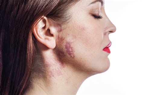 What Are Pigmented Birthmarks Apollo Hospital Blog